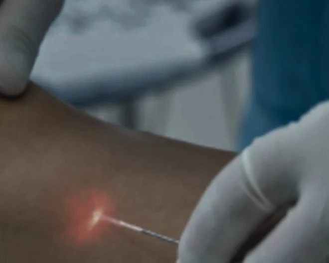 A luz vermelha da fibra de laser vista através da pele, dentro da veia, durante o endolaser