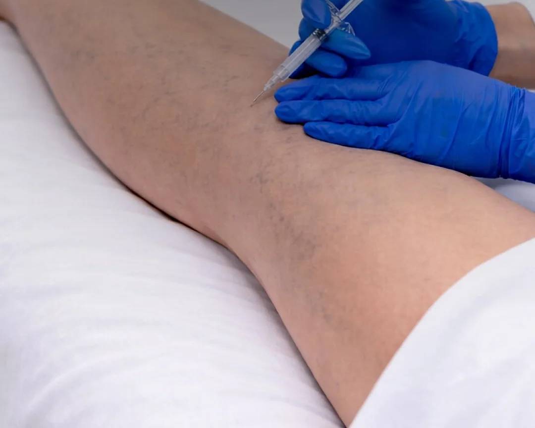 Mãos com luvas azuis aplicando o medicamento com uma seringa fina na perna, durante uma escleroterapia