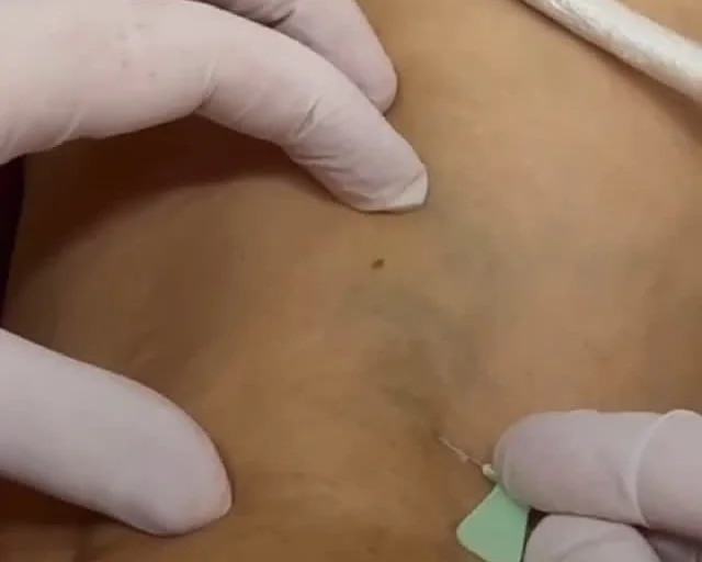 Mãos com luvas esticando a pele da perna enquanto a agulha fina aplica a espuma dentro da veia